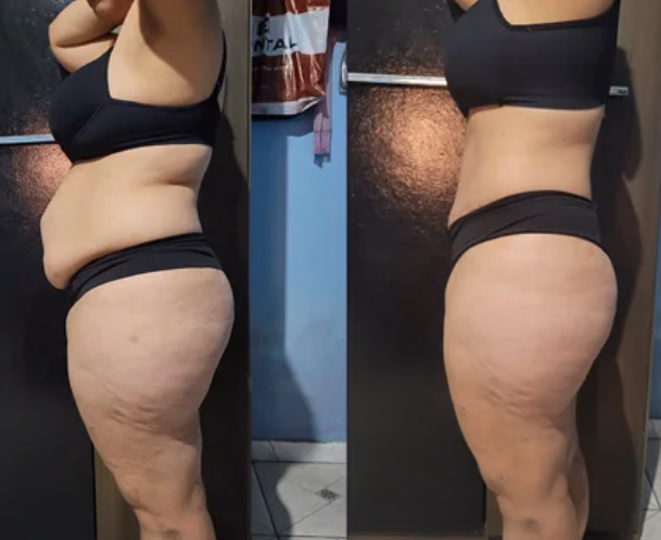 Marcela — antes e depois com o Protocolo 5D